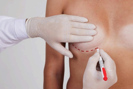 Breast Lift vs. Breast Augmentation: Which Is Right for You? Breast Lift vs. Breast Augmentation: Which Is Right for You