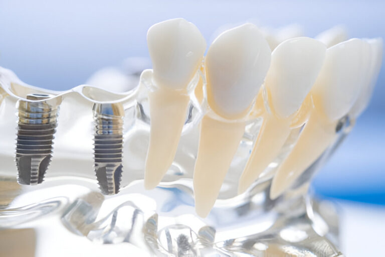 The Essential Guide to Affordable Dental Implants The Essential Guide to Affordable Dental Implants